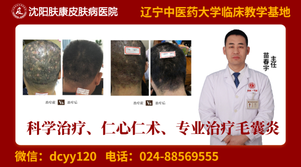 沈阳肤康皮肤病医院头皮部毛囊炎总反复怎么办毛囊炎是什么原因引起的