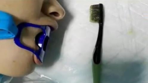 女子刷牙时15厘米牙刷滑进胃里 送医后取出