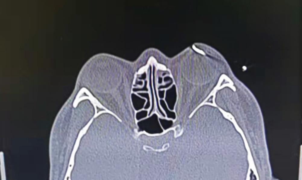 ct示左侧眼球晶状体前可见条状高密度异物