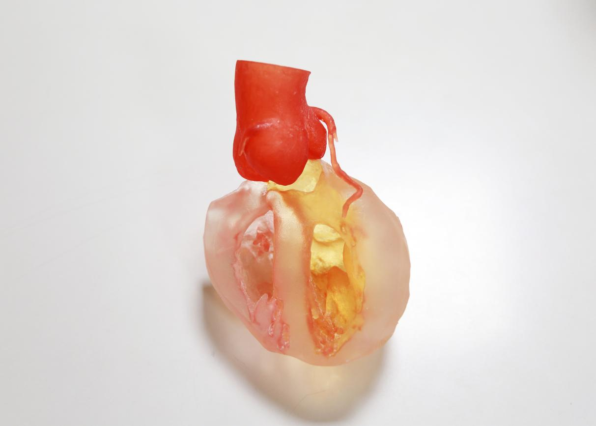 3d打印技術加持17歲少年精準實施二次心臟手術