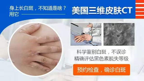 成都西部白癜风医院