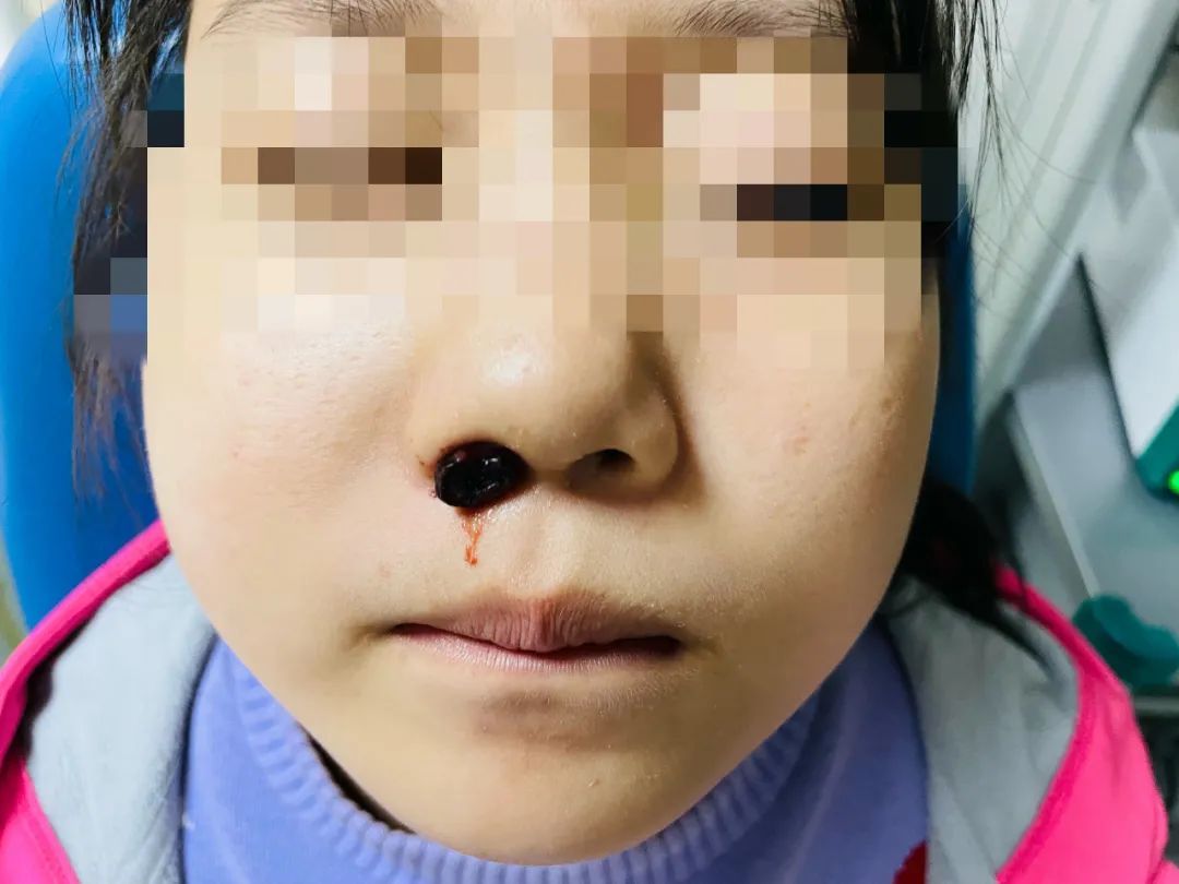 西安市第三医院耳鼻喉科成功切除一例少见儿童出血性鼻息肉