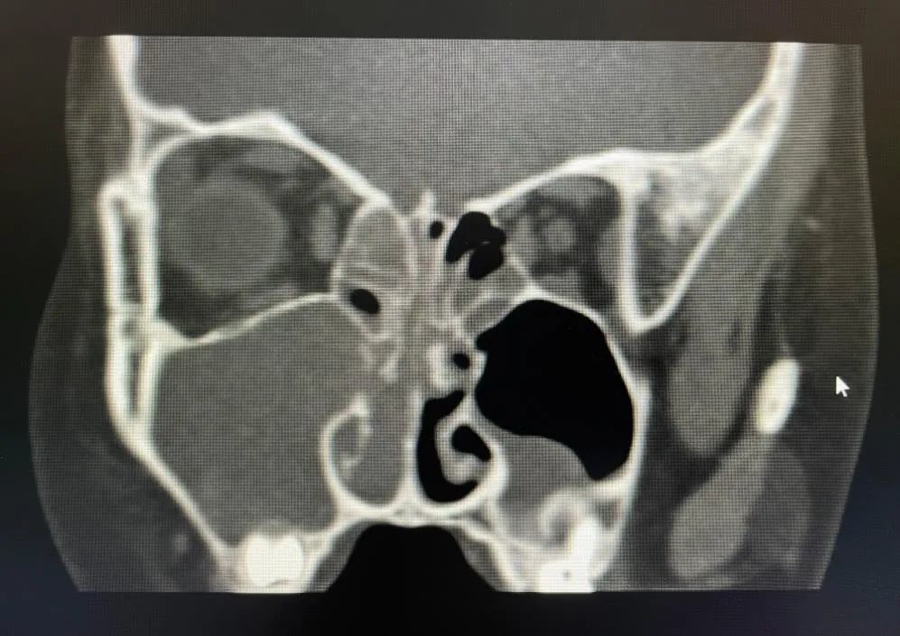 西安市第三医院耳鼻喉科成功切除一例少见儿童出血性鼻息肉