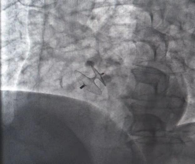 封堵器及介入封堵示意图