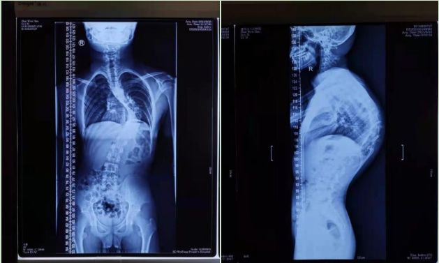 潍坊市人民医院15岁驼背男孩手术增高近18厘米