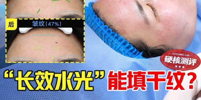 号称能拯救熬夜脸的润致娃娃针，真能补水平纹吗？