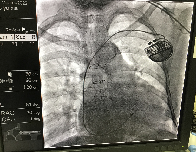 西安交大二附院:穿30斤铠甲的“大白”为患者实施心脏手术