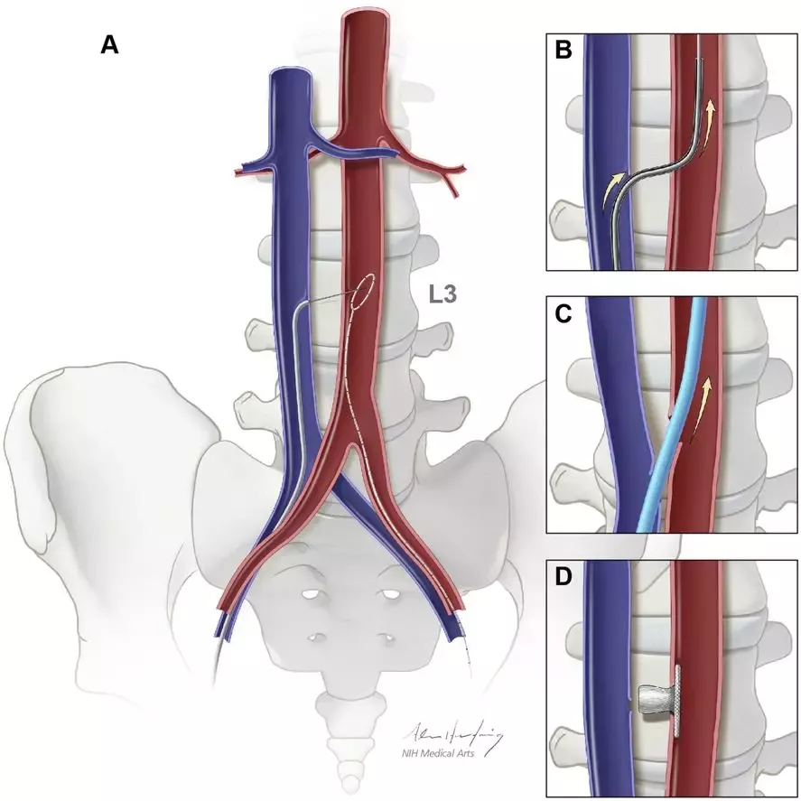 经腔静脉tavi手术入路和闭合示意图