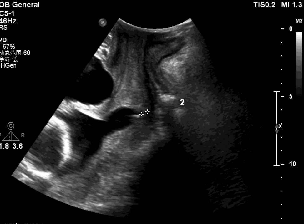 宫外孕b超单 真实图片