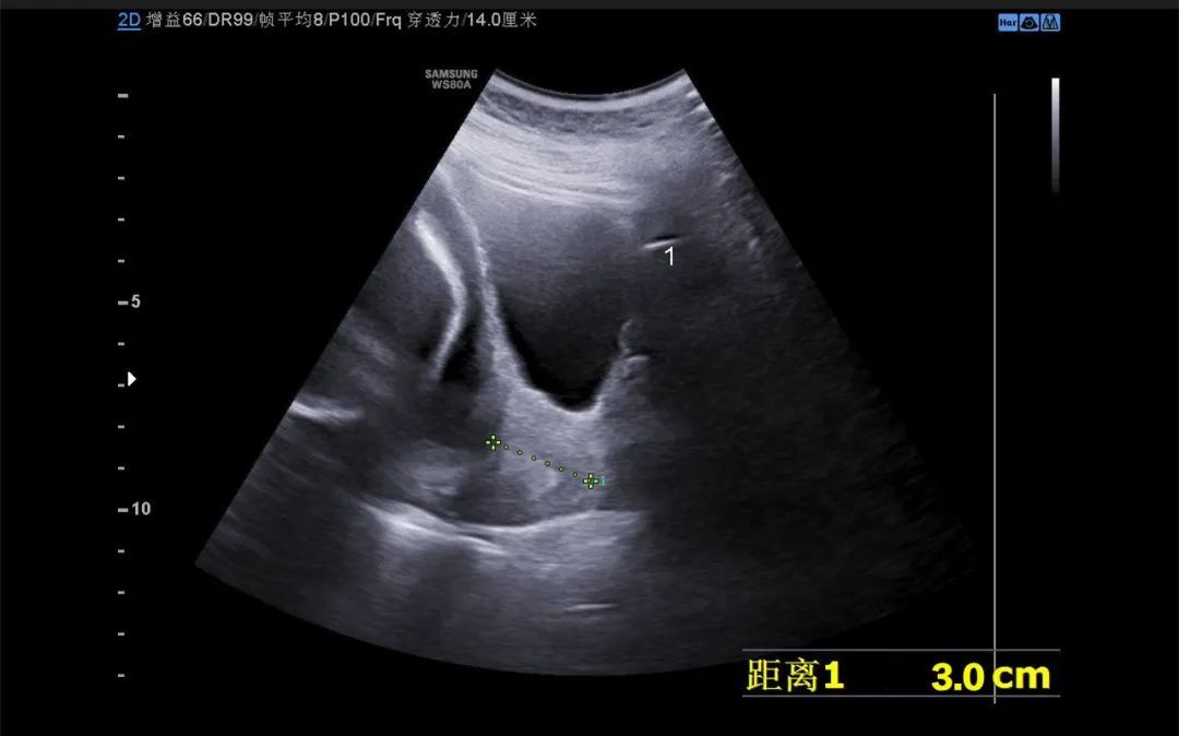 怀孕一个月的B超图片图片