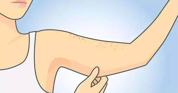 鸡皮肤拔火罐有用吗(鸡皮肤拔火罐有用吗图片) 鸡皮肤拔火罐有用吗(鸡皮肤拔火罐有用吗图片)