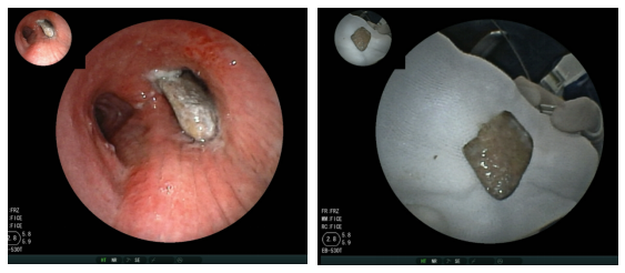 惹事骨头误入气途支气管镜巧取化险为夷