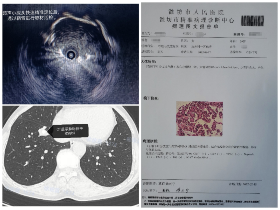 肺癌化验报告单图片图片