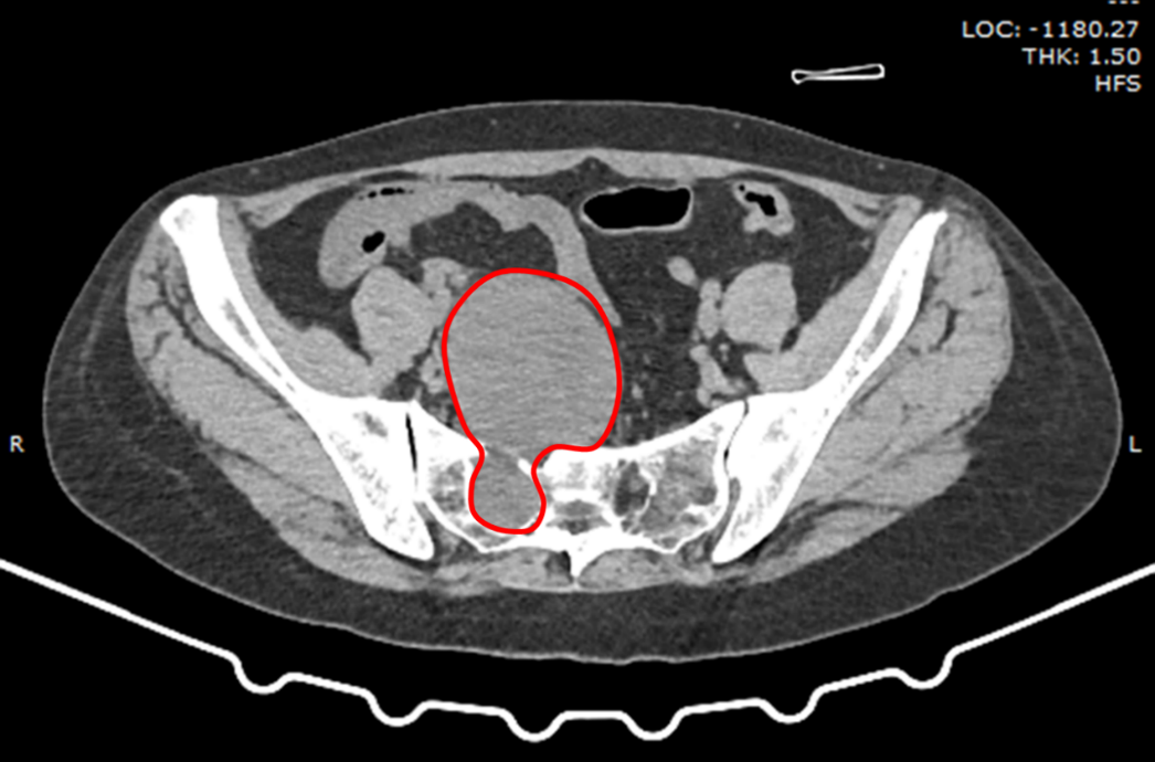 神经鞘瘤形状似葫芦 西安市红会医院消化外科与神经外科联手切除