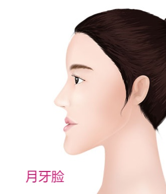 牙齿矫正四种人正畸后脸型变化最大