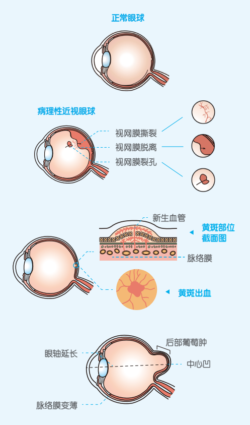 西安市人民醫院孩子近視別隻關心度數眼軸眼底全面監測更科學