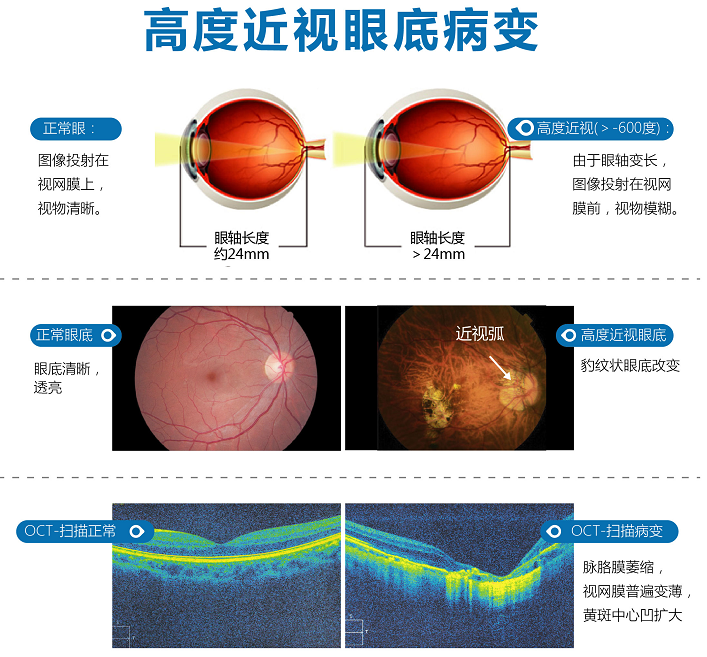 高度近视戴眼镜也模糊 精准EVO—ICL人工晶体植入重返高清视界