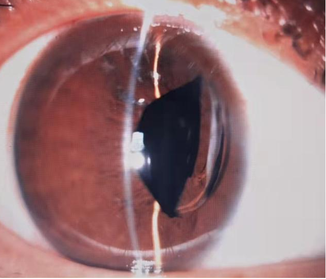 市一院首例微创缝线固定囊袋矫正人工晶体脱位手术