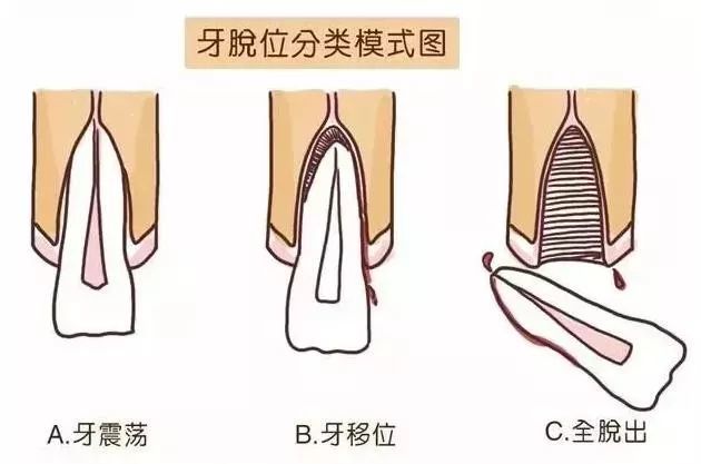 10龄童意外磕断门牙牙根骨下盲接让牙齿起死回生