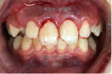 牙床露出白色骨头图片