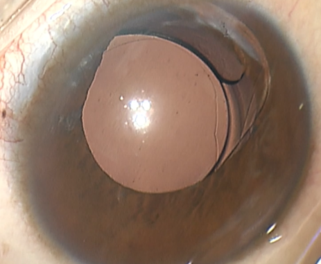 市一院首例微创缝线固定囊袋矫正人工晶体脱位手术