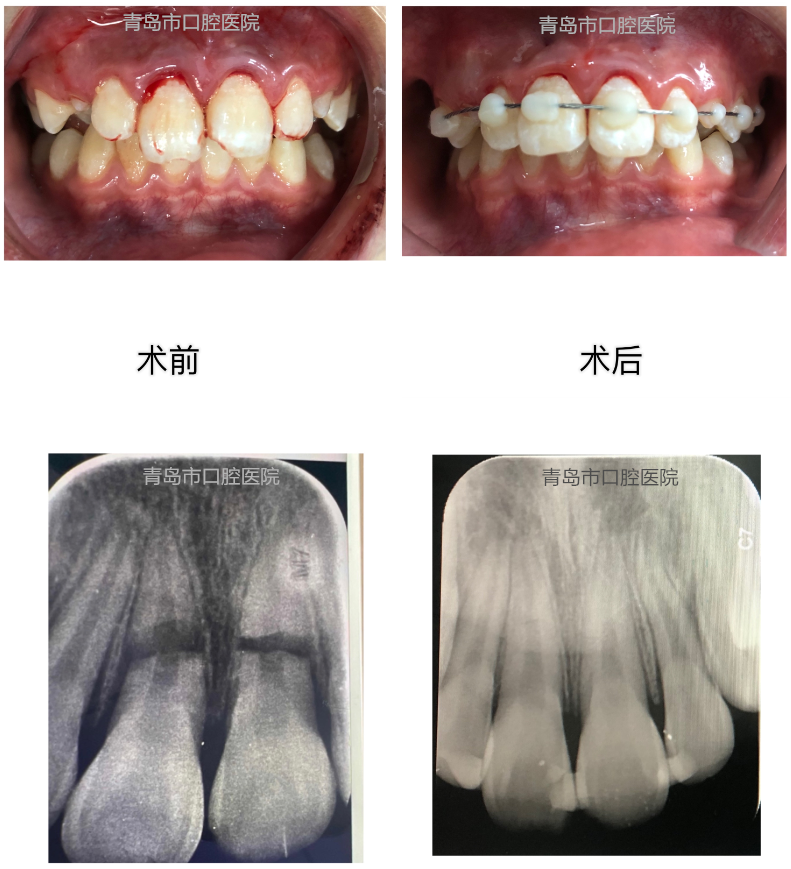 牙槽骨断裂图片图片