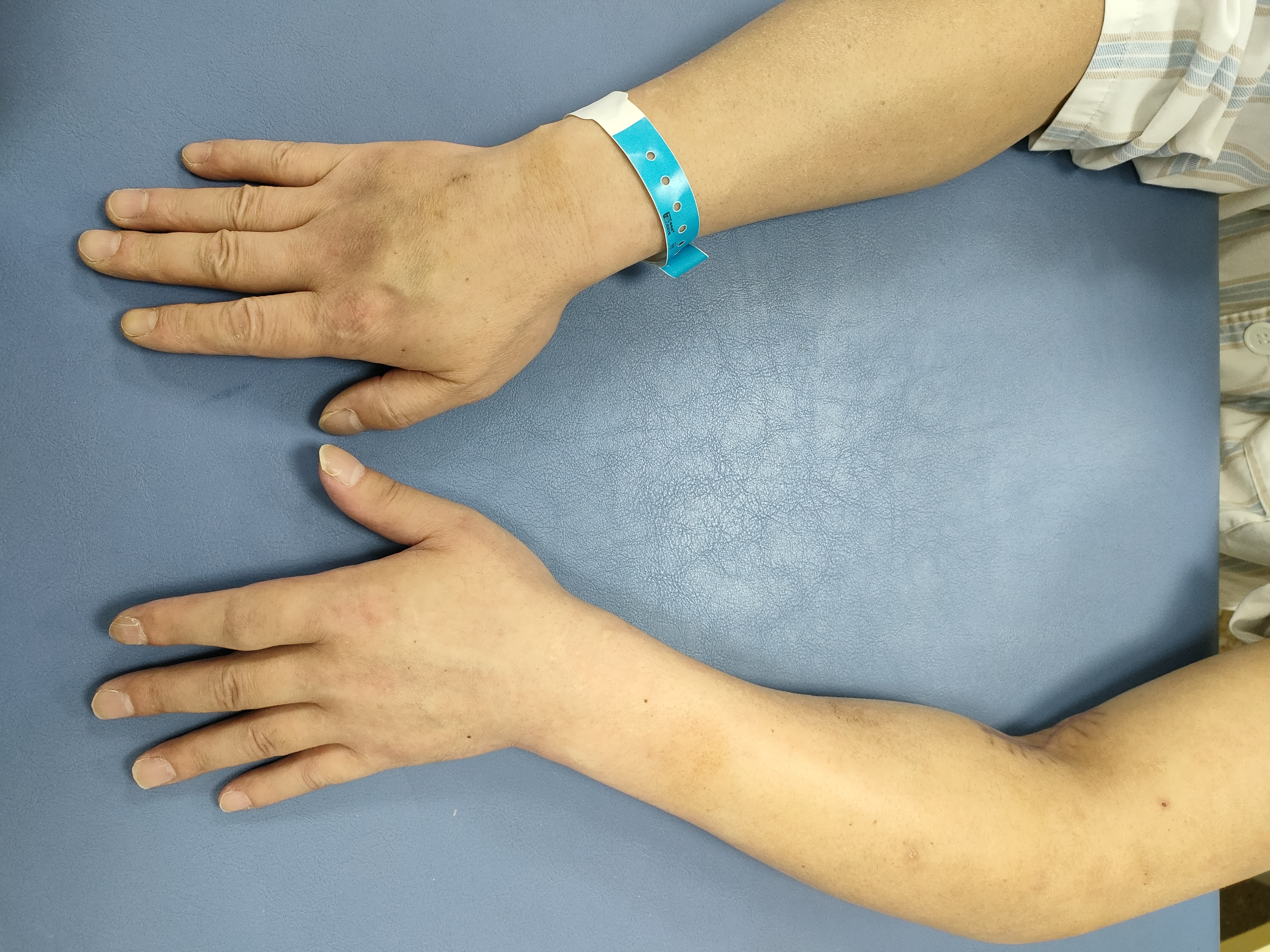 压力绷带为什么那么贵西安市红会医院：“淋巴水肿”不可忽视的元凶之一_https://www.jmylbn.com_新闻资讯_第1张