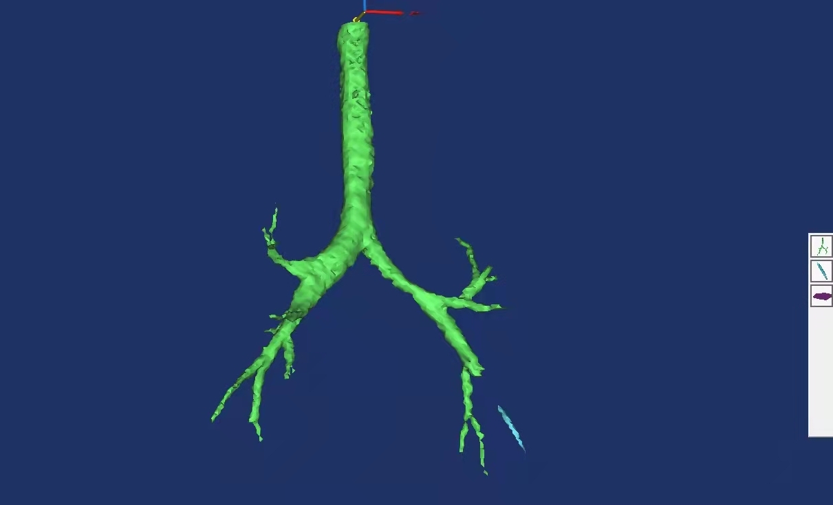 右肺支气管三维图图片