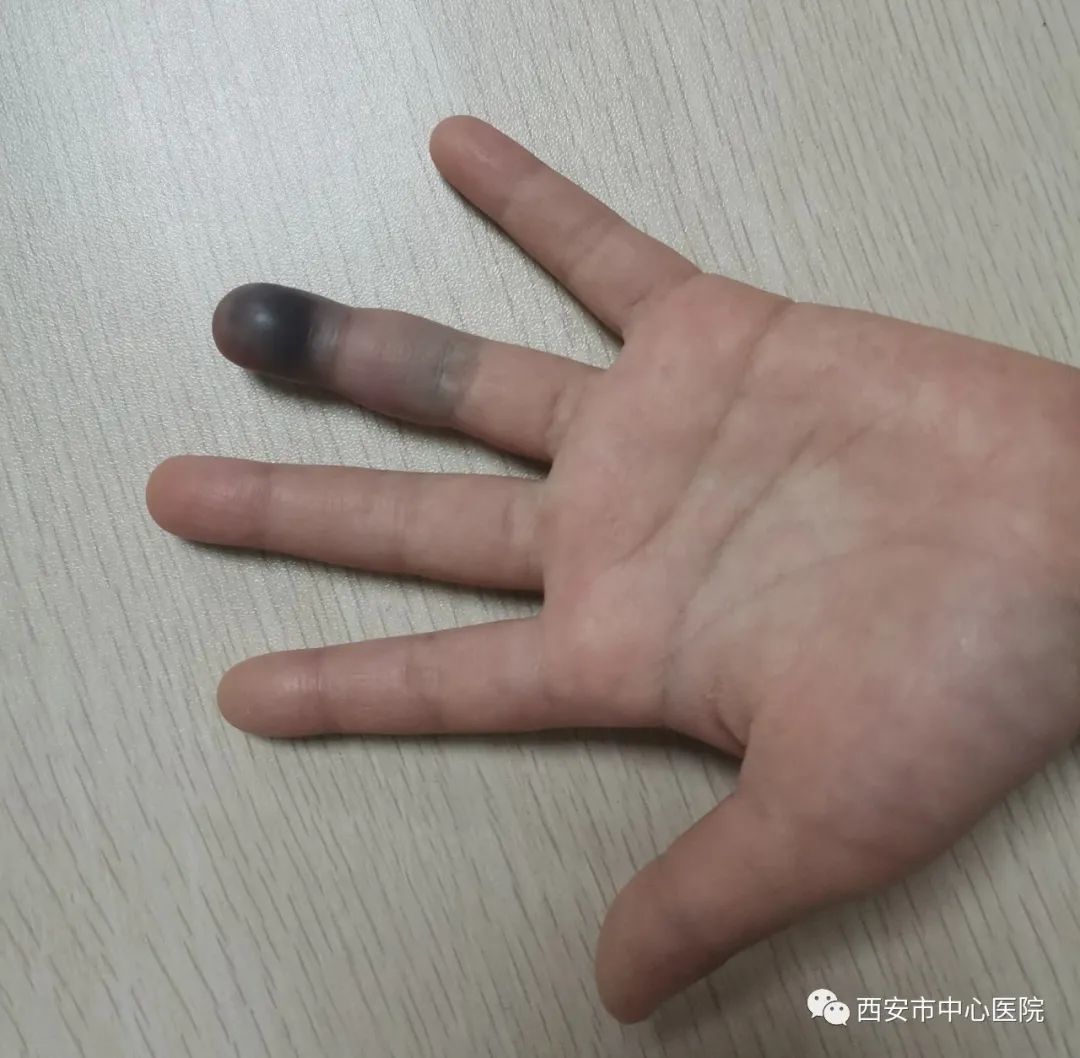 儿童手指被夹肿胀黑紫图片