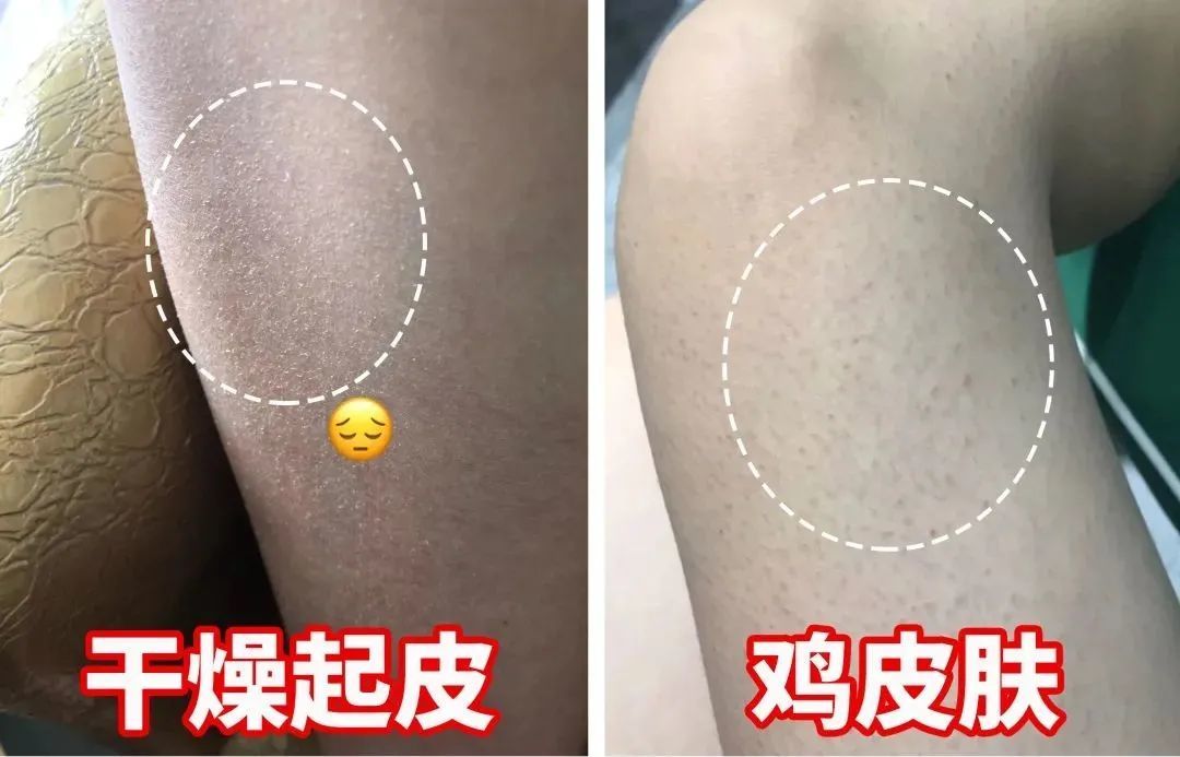 夏天拖去衣服起鸡皮疙瘩(为什么一到夏天就起鸡皮疙瘩)