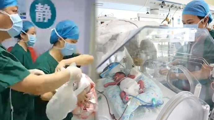24岁产妇早产1女4男5胞胎：体重最大1.4公斤，都用上了呼吸机