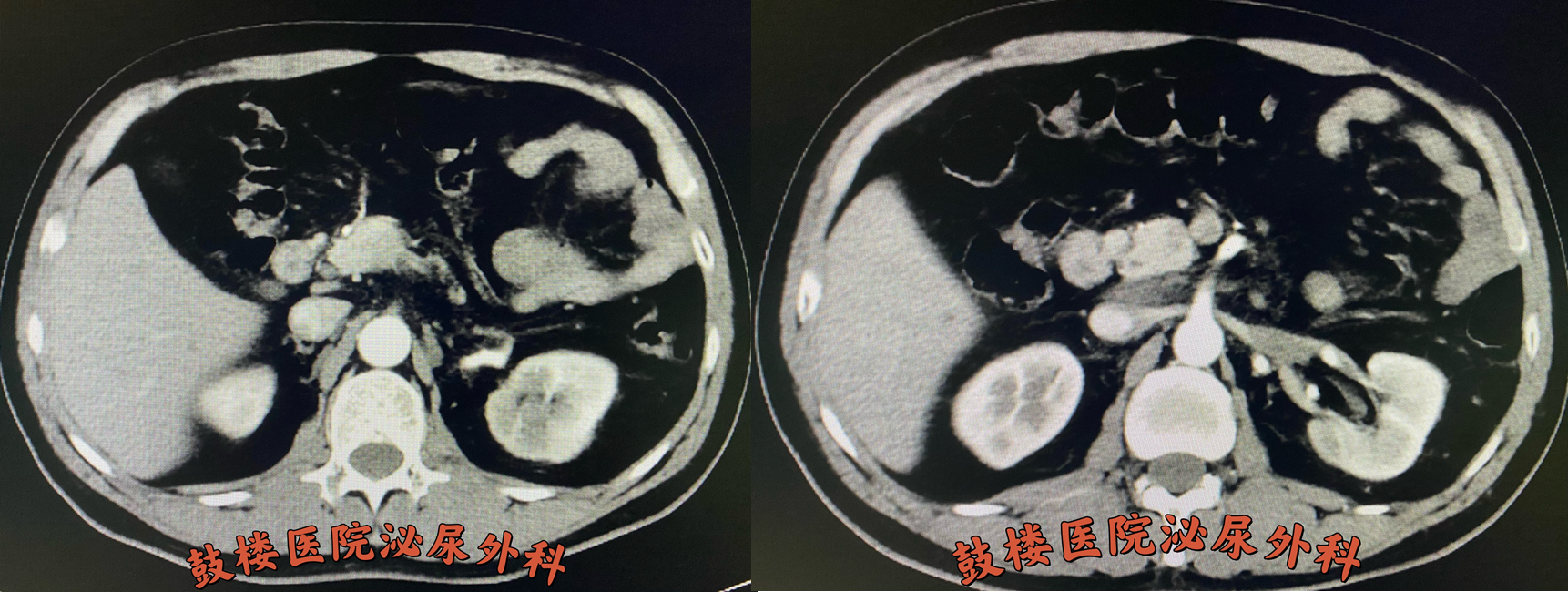 新辅助治疗后左肾肿瘤几乎消失,左肾静脉瘤栓明显缩小。