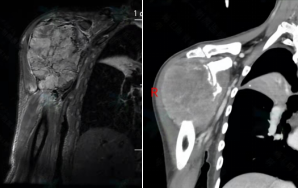 肩關節mri和ct示:右肩關節失去正常形態,並可見巨大腫塊,肱骨近端及