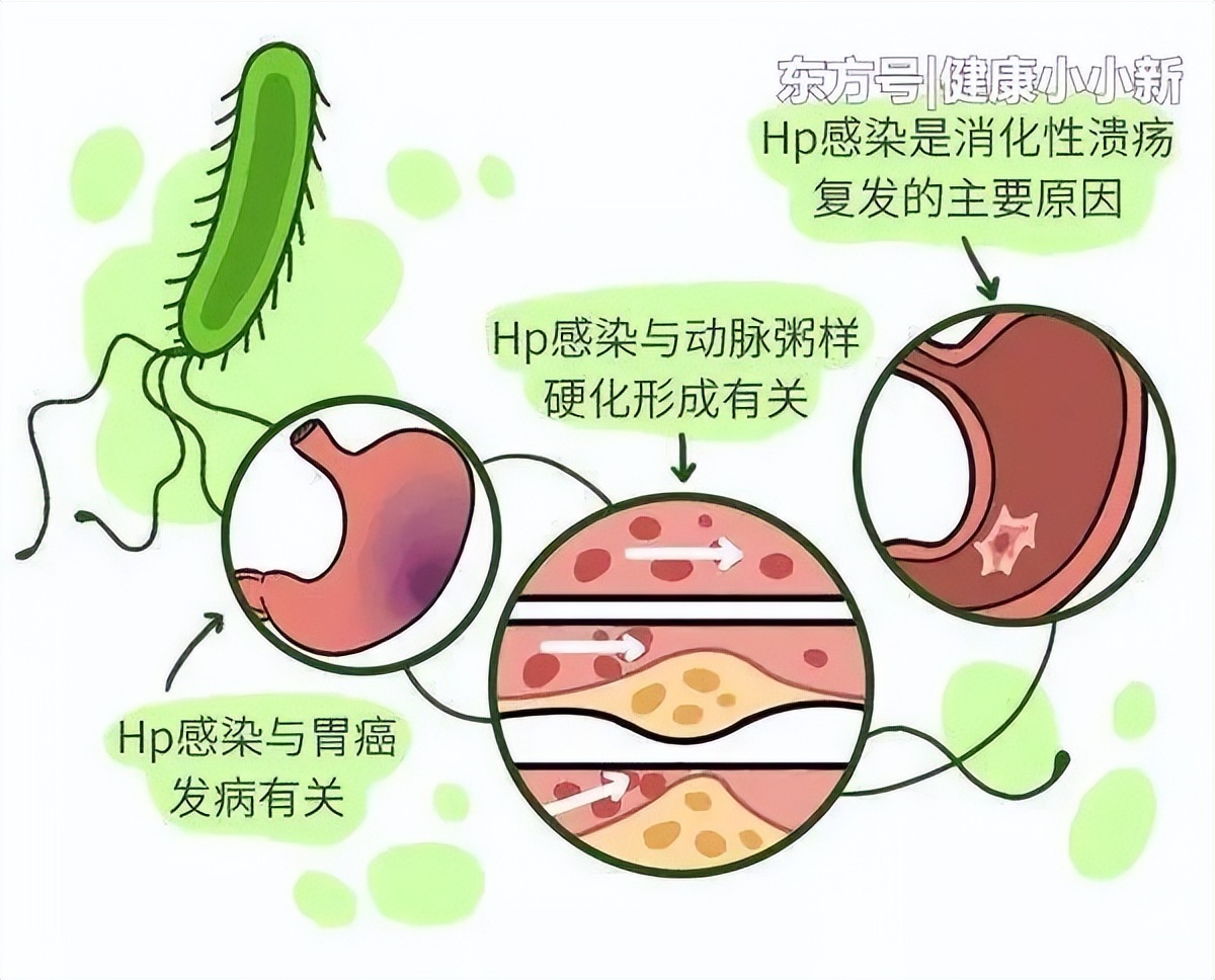 【豫健科普】与幽门螺杆菌相关的胃外疾病有哪些？