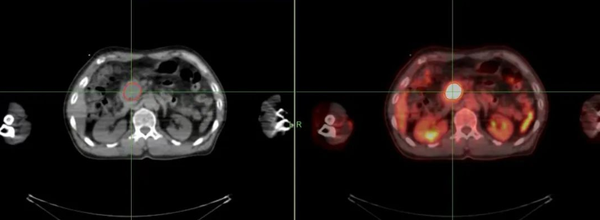 世博高新医院精准定位精确计划世博高新医院实现petct精准放疗定位