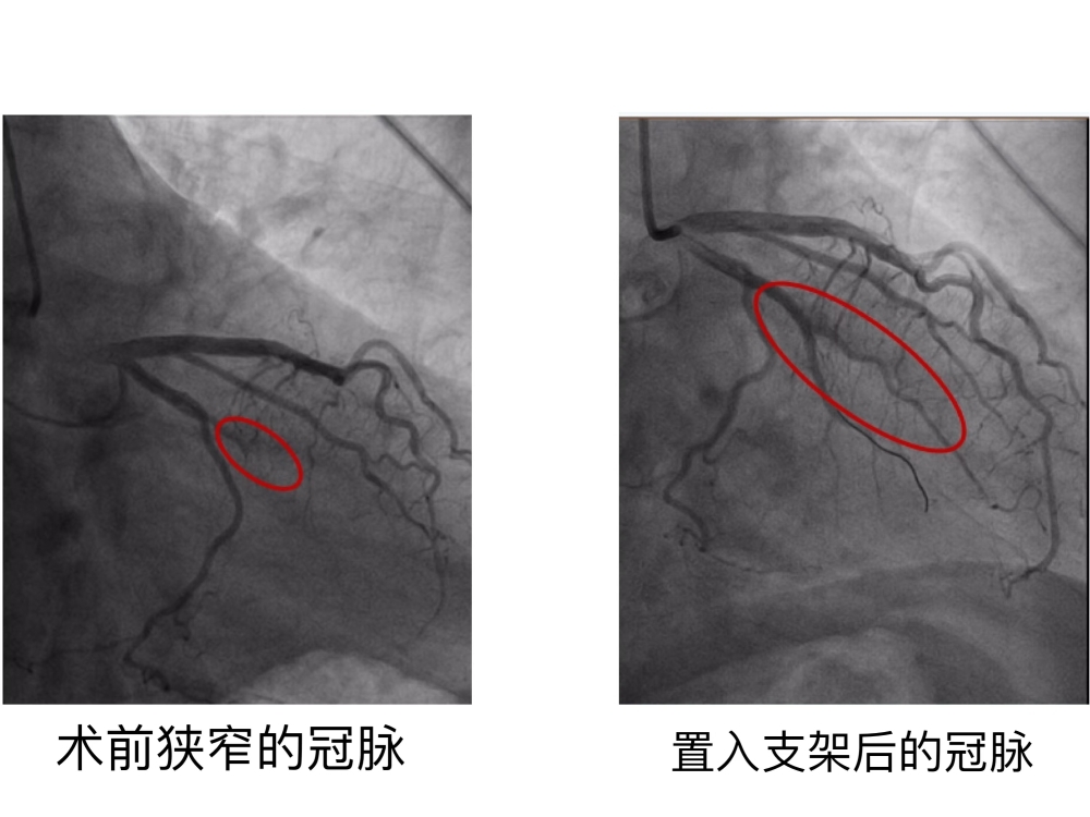 注意咽喉疼痛病根确是心梗