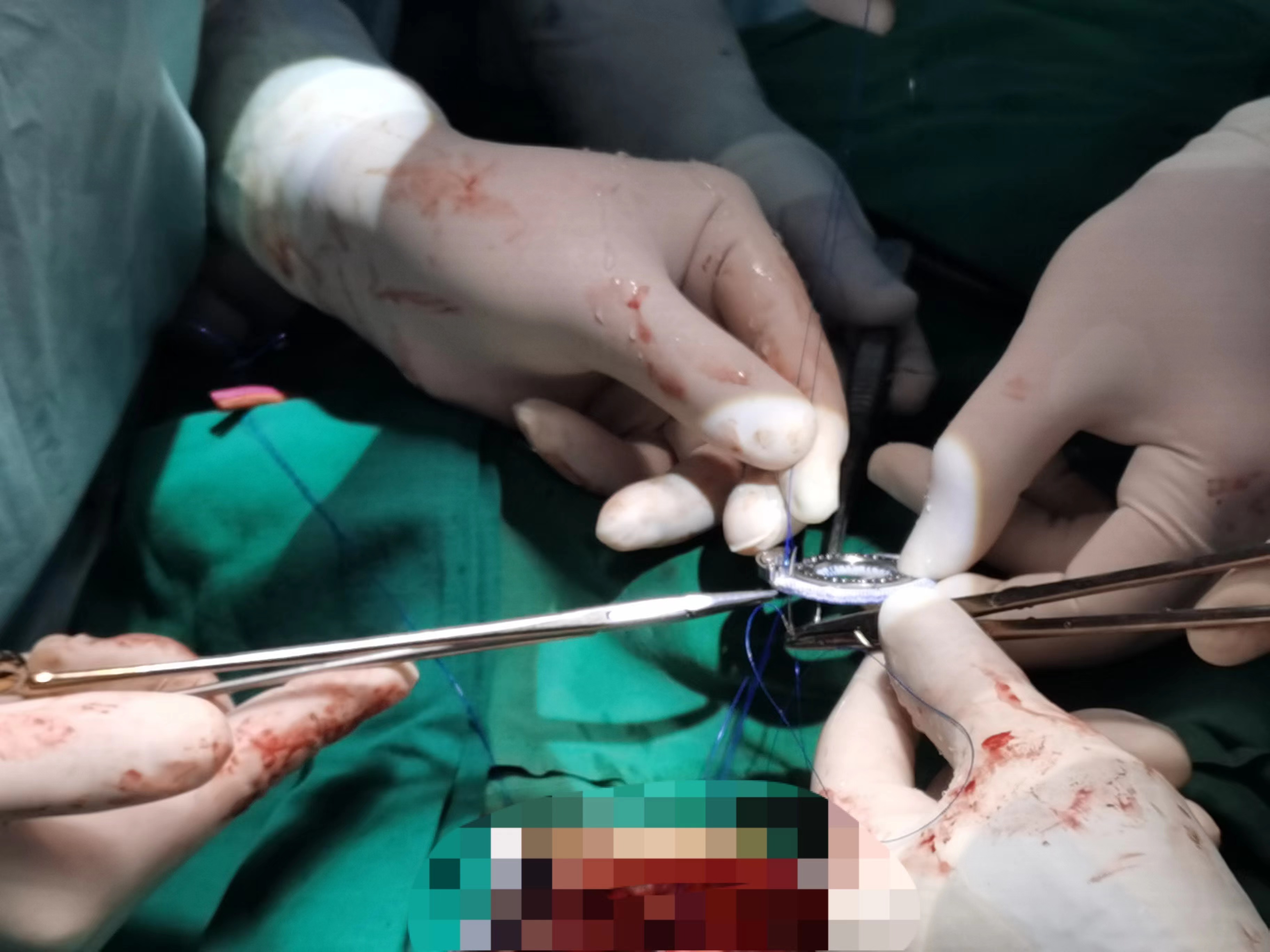 再植“中国心”  南京市第一医院成功为66岁老人完成磁浮悬人工心脏植入术