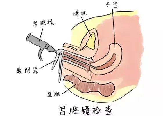 阴镜检是怎么检查的图片