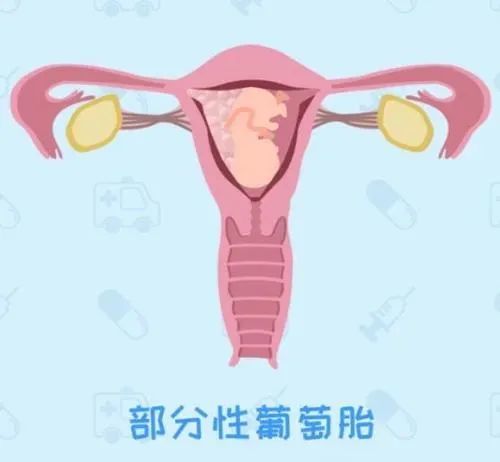潍坊市人民医院孕早期阴道流血一定发生自然流产吗