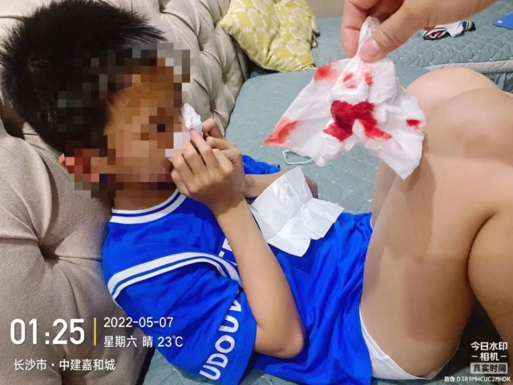 湖南长沙中建嘉和城小区，部分儿童出现不明原因鼻出血症状