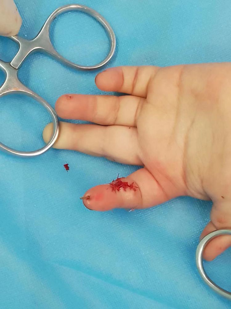 恐怖电梯夹手指各方接力保平安