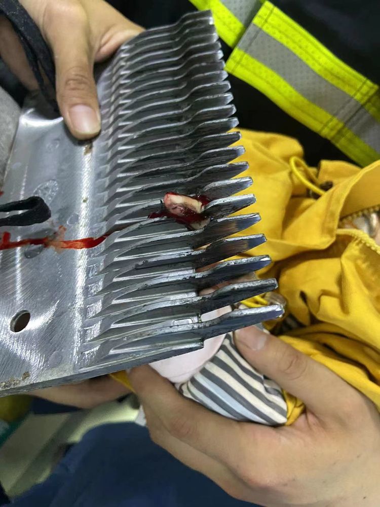 恐怖电梯夹手指 各方接力保平安