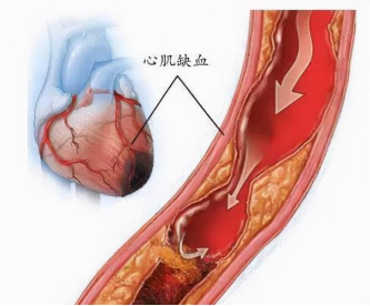 冠心病心肌缺血有什麼症狀和表現心肌缺血吃什麼藥