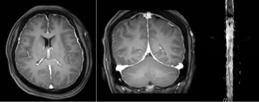 患者术前颅脑MR（左2）可见脑膜明显强化，并存在脑脊液漏（右1，脊髓水成象）