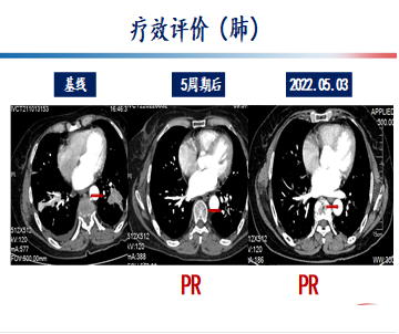 喜讯:潍坊市中医院荣获拾全识美肺癌mdt病例挑战赛城际赛冠军凤凰网