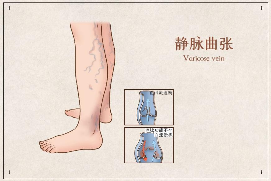 血管腔内微创激光闭合术,改良大隐静脉高位结扎和剥脱术,曲张静脉点式