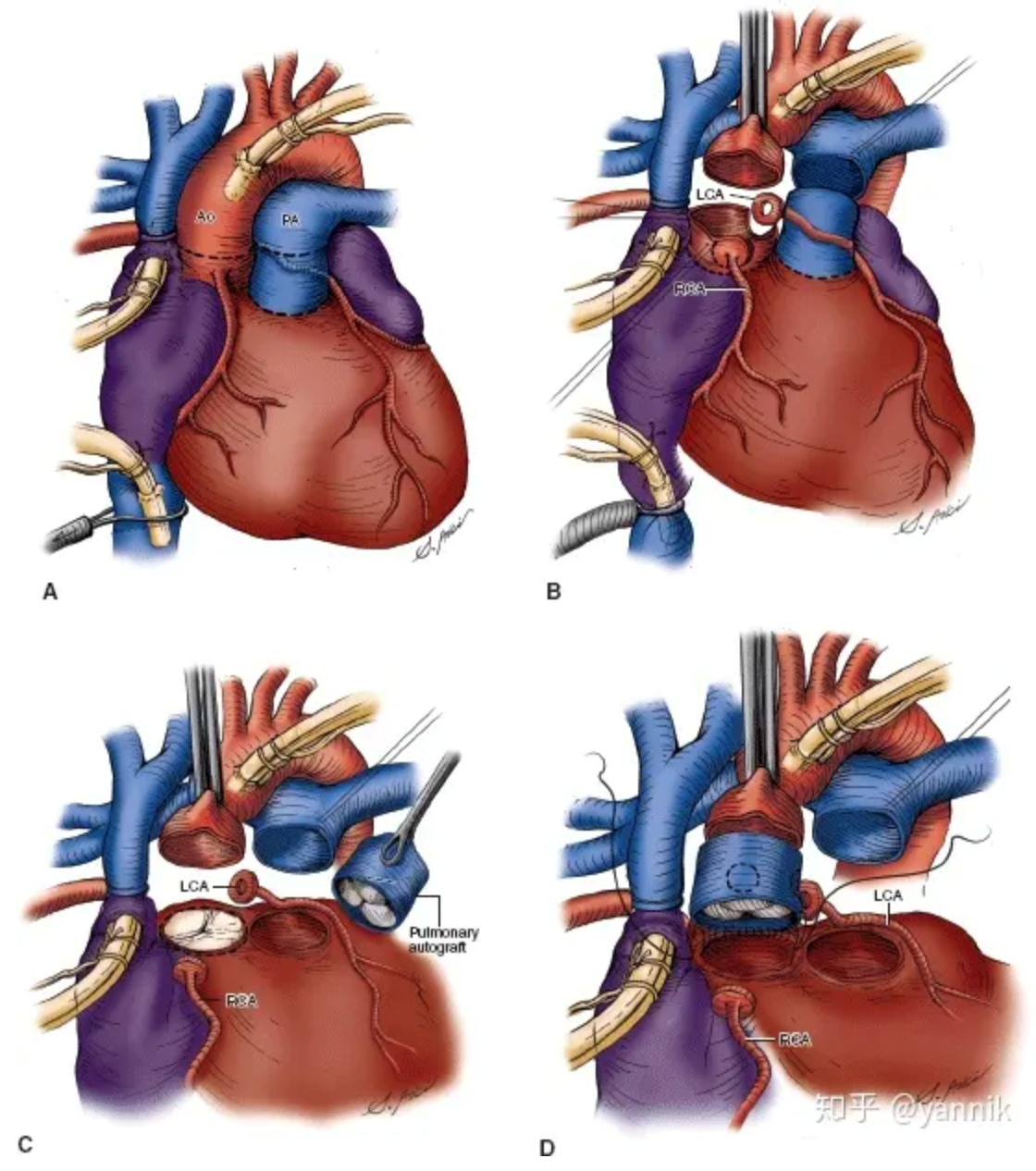 动脉导管未闭-胸心外科解剖-医学