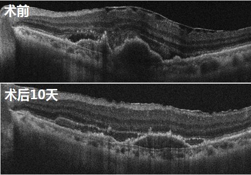 图4术前OCT示黄斑区层间出血及RPE层下出血（上图）；术后10天OCT示黄斑区层间及RPE层下出血明显减少（下图）。