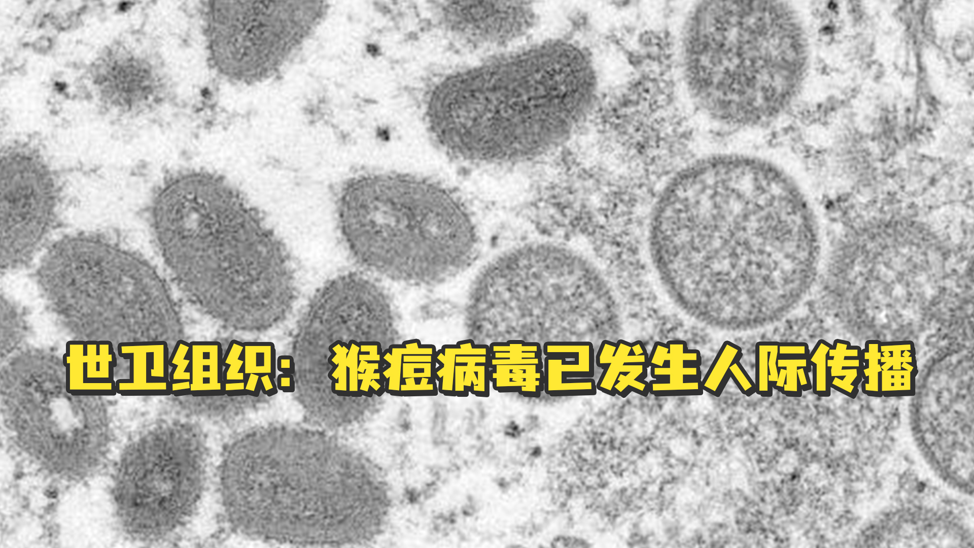 世卫组织:猴痘病毒已发生人际传播,还可经由母婴和性传播