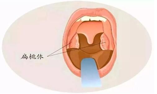 扁桃體炎化膿了怎麼辦成都民生耳鼻喉醫院治療效果棒值得信任